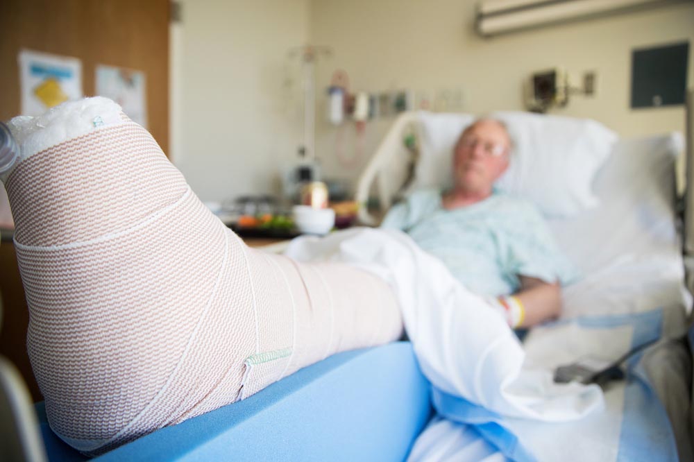 Broken leg in cast with patient in hospital bed